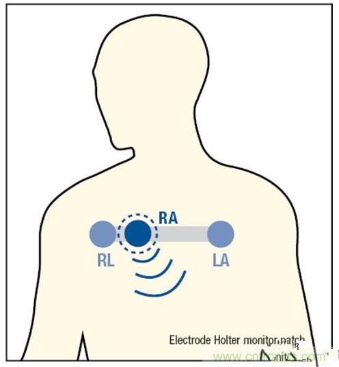 解析：一款可穿戴無(wú)線ECG動(dòng)態(tài)心電監(jiān)護(hù)儀的設(shè)計(jì)